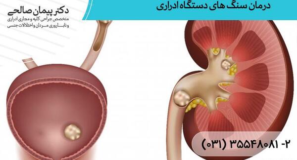 عکس سنگ داخل مثانه