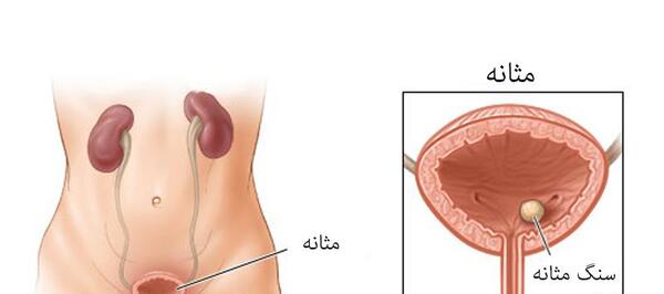عکس سنگ داخل مثانه