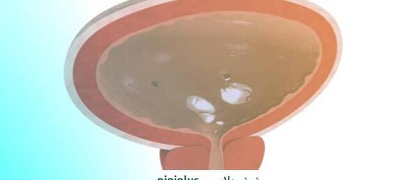 عکس سنگ داخل مثانه