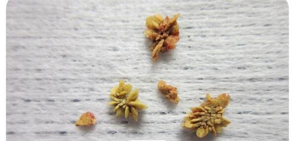 عکس سنگ داخل مثانه