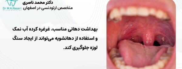 عکس سنگ گلو