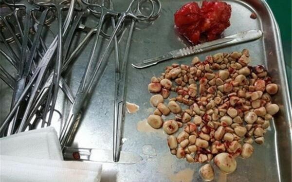 عکس سنگ کلیه در مثانه