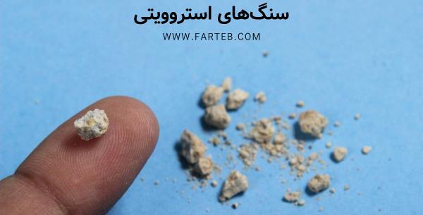 عکس سنگ کلیه در مثانه