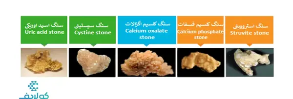 عکس سنگ کلیه در مثانه