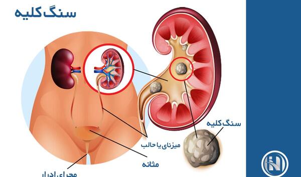 عکس سنگ کلیه در مثانه