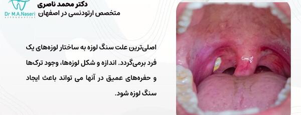 عکس سنگ لوزه ها