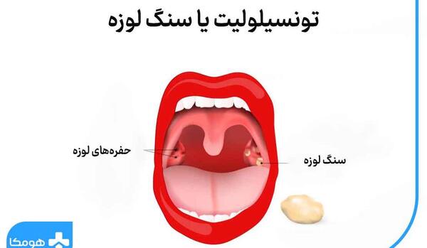 عکس سنگ لوزه ها