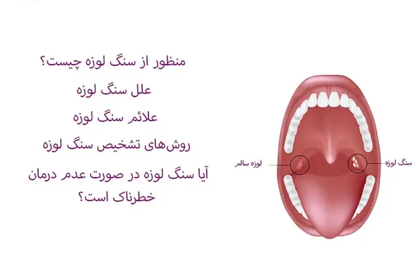 عکس عكس سنگ لوزه