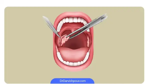 عکس سنگ لوزه پنهان