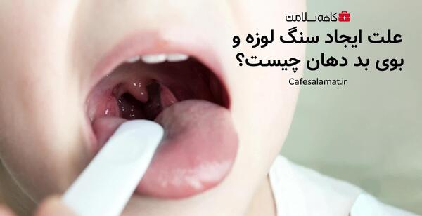 عکس سنگ لوزه پنهان