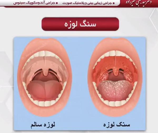 عکس سنگ لوزه پنهان