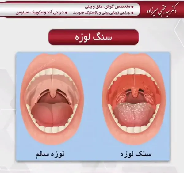 عکس سنگ لوزه کوچک