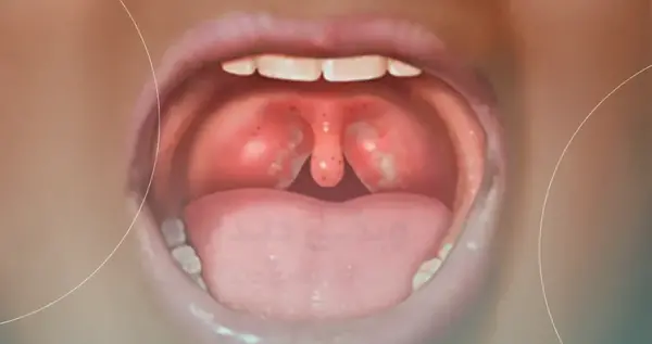 عکس سنگ لوزه کوچک
