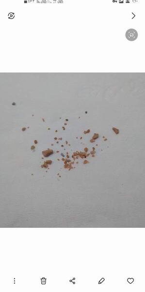 عکس سنگ کلیه 4 میلیمتری نی نی سایت