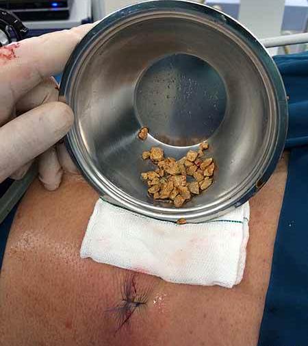 عکس سنگ کلیه 4 میلیمتری نی نی سایت