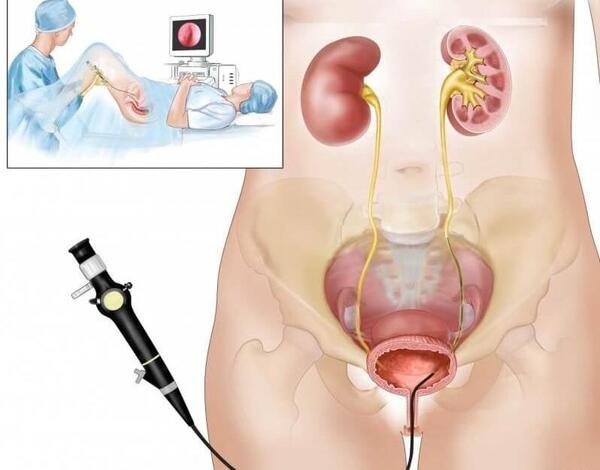 عکس سنگ کلیه 4 میلیمتری نی نی سایت