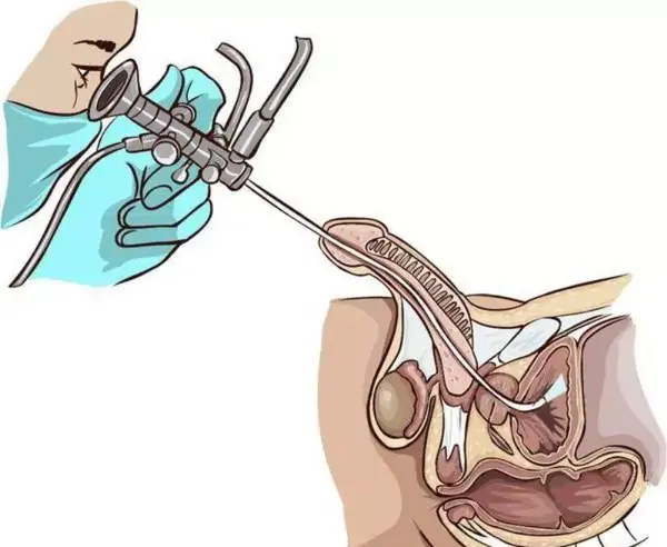 عکس سنگ کلیه 4 میلیمتری نی نی سایت