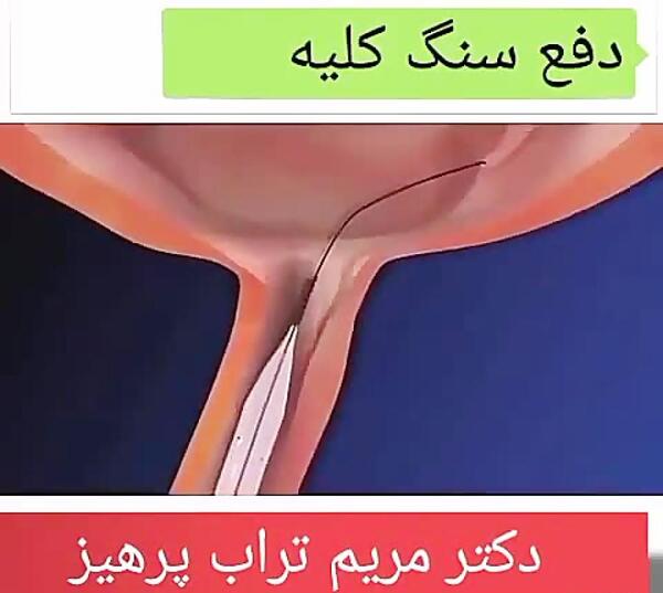 عکس سنگ کلیه در بدن انسان
