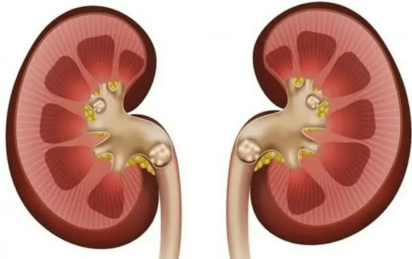 عکس سنگ کلیه در بدن انسان