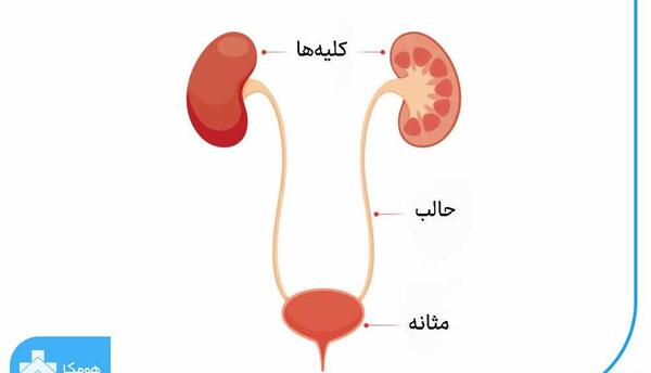 لوله حالب عکس سنگ کلیه 4 میلیمتری