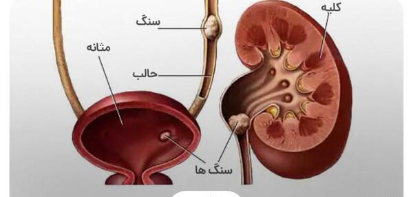 لوله حالب عکس سنگ کلیه 4 میلیمتری