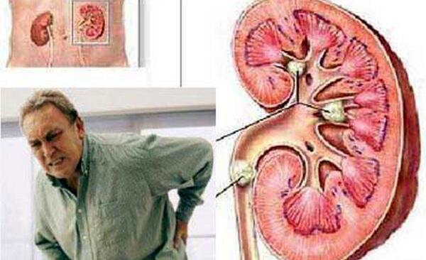 لوله حالب عکس سنگ کلیه 4 میلیمتری
