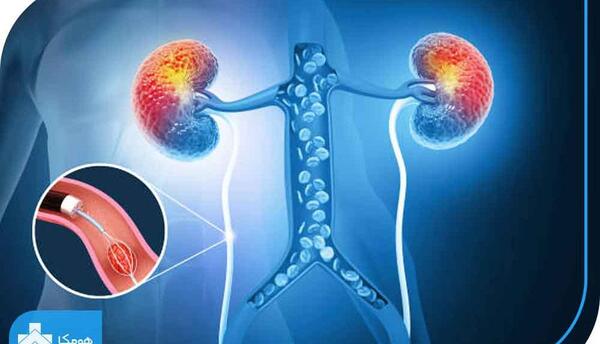 لوله حالب عکس سنگ کلیه 4 میلیمتری