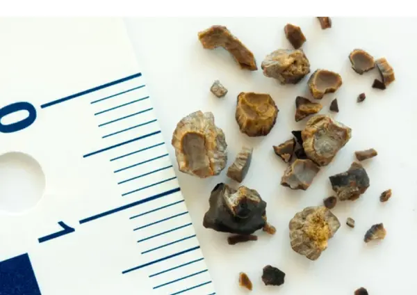 لوله حالب عکس سنگ کلیه 4 میلیمتری