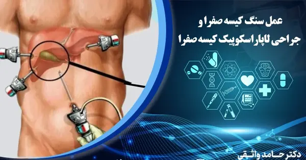 عکس از سنگ کیسه صفرا