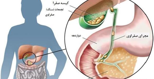عکس از سنگ کیسه صفرا