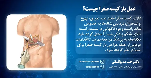 عکس از سنگ کیسه صفرا