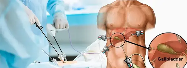 عکس سنگ صفرای گاو