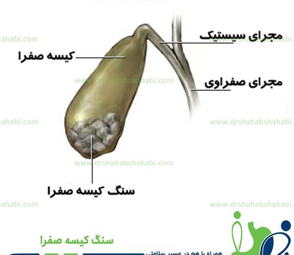 عکس سنگ کیسه صفرا چیست