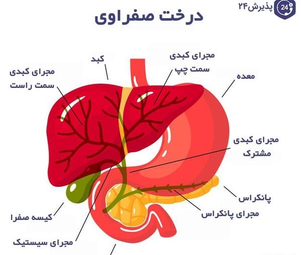 عکس سنگ کیسه صفرا چیست