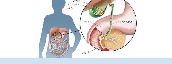 عکس سنگ کیسه صفرا چیست