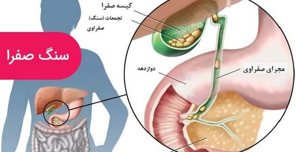 عکس سنگ کیسه صفرا چیست