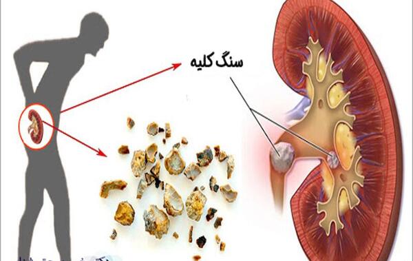 عکس رنگی سنگ کلیه