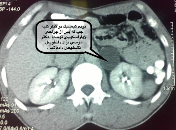 عکس سنگ کلیه در سی تی اسکن