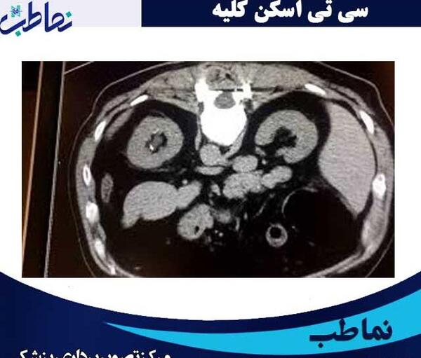عکس سنگ کلیه در سی تی اسکن