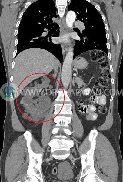 عکس سنگ کلیه در سی تی اسکن