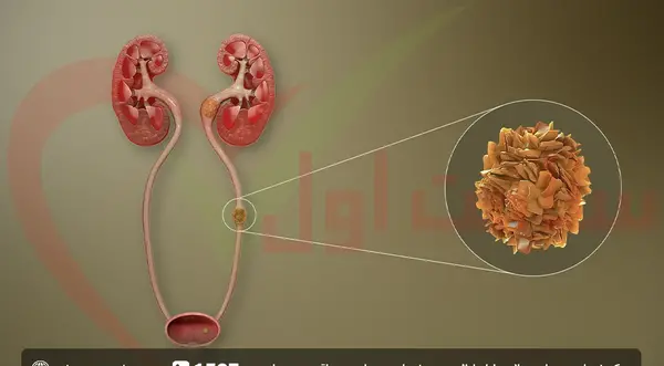 عکس سنگ کلیه 7 میلیمتری