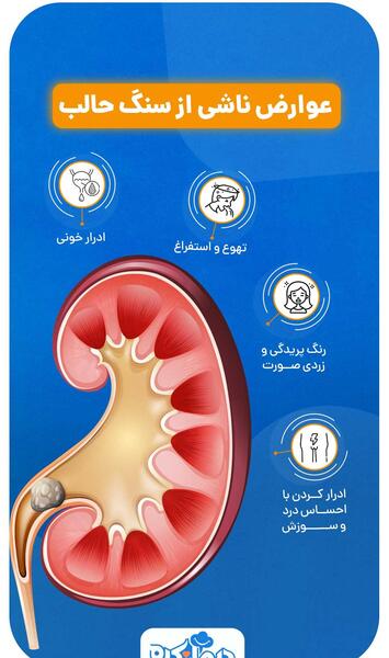 عکس سنگ کلیه 7 میلیمتری