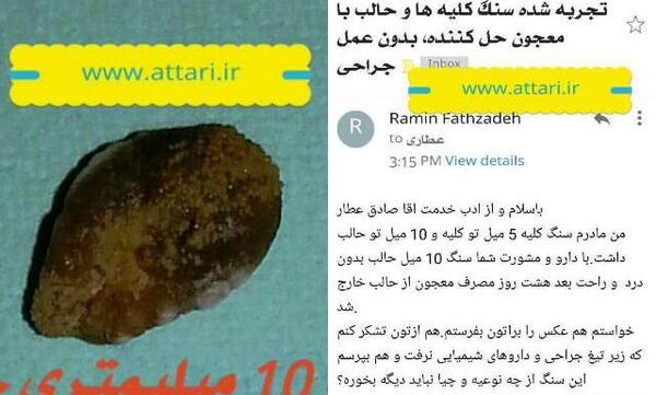 عکس سنگ کلیه 7 میلیمتری