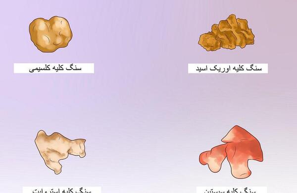 عکس سنگ کلیه 7 میلیمتری