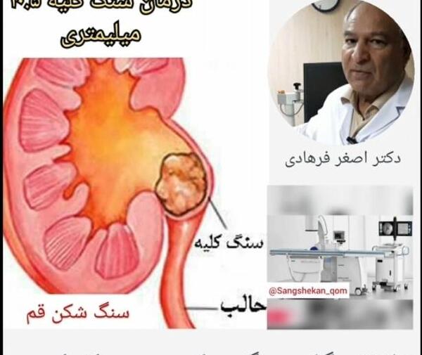 عکس سنگ کلیه 7 میلیمتری