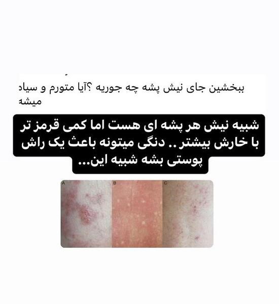 عکس نیش پشه دنگی