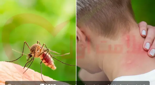 عکس جای نیش انواع پشه ها