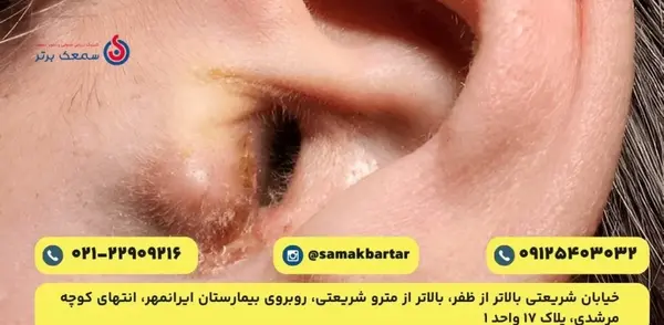عکس داخل گوش عفونت کرده