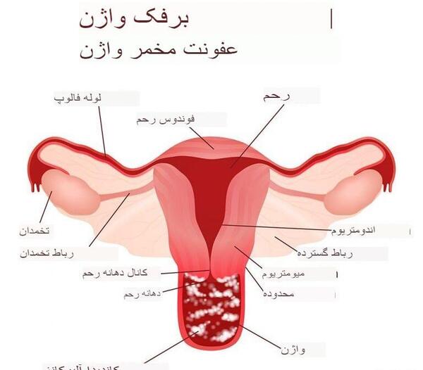عکس عفونت قارچی داخل واژن