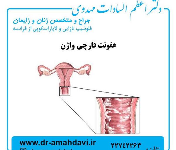 عکس عفونت قارچی داخل واژن